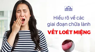 Hiểu rõ về các giai đoạn chữa lành vết loét miệng