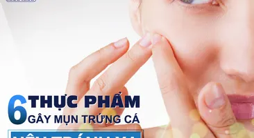 6 loại thực phẩm có thể gây ra mụn trứng cá bạn cần tránh xa