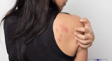 Bật mí các phương pháp điều trị mề đay mãn tính hiệu quả