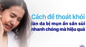 Giải pháp thoát khỏi làn da bị mụn ẩn sần sùi nhanh chóng 