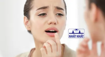 Giải đáp: Nhiệt lưỡi uống thuốc gì nhanh khỏi?