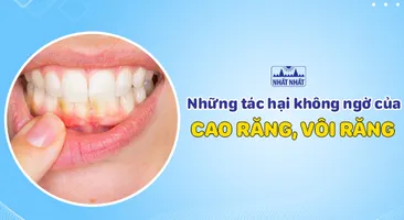 Những tác hại không ngờ của cao răng, vôi răng