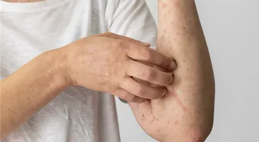 Giải mã bệnh nổi mề đay – nỗi ám ảnh của không ít người
