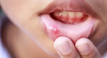 Xử lý nhanh nhiệt miệng ở trẻ em