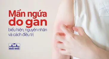 Mẩn ngứa do gan: biểu hiện, nguyên nhân và cách điều trị 