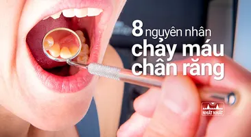 Loại bỏ ngay 8 nguyên nhân gây chảy máu chân răng