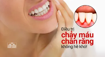 Điều trị chảy máu chân răng không hề khó!