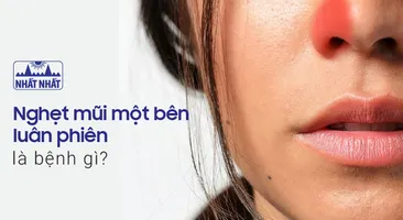 Nghẹt mũi một bên luân phiên là bệnh gì?
