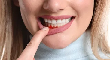 Những nguy hiểm tiềm ẩn khi bị chảy máu chân răng liên tục