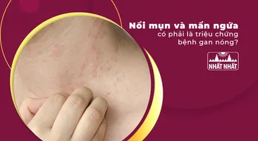 Nổi mụn và mẩn ngứa có phải là triệu chứng bệnh gan nóng?