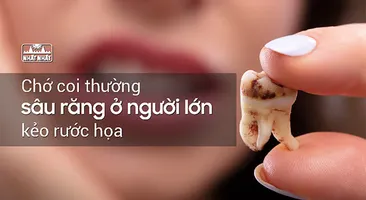 Chớ coi thường sâu răng ở người lớn kẻo rước họa!