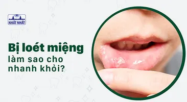 Bị loét miệng làm sao cho nhanh khỏi?
