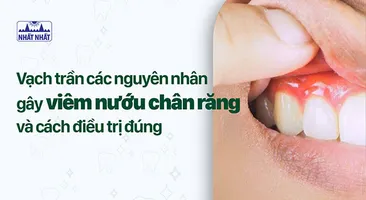 Vạch trần các nguyên nhân gây viêm nướu chân răng và cách điều trị đúng