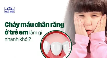 Chảy máu chân răng ở trẻ em làm gì nhanh khỏi?