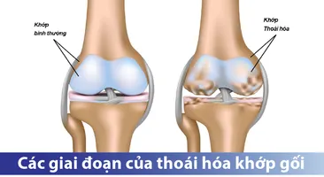 Tìm hiểu 4 giai đoạn của bệnh thoái hóa khớp gối