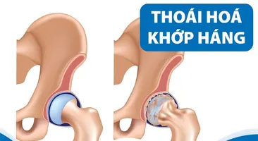 Bệnh thoái hóa khớp háng ở người trẻ: Những thông tin ít người biết