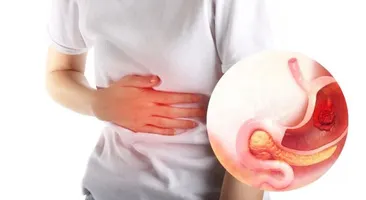 Loét dạ dày triệu chứng cảnh báo cần điều trị ngay!