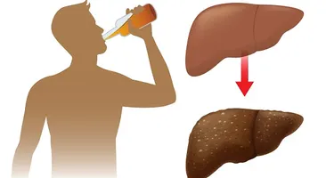 Cảnh báo những biến chứng nguy hiểm của viêm gan do rượu