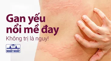 Gan yếu nổi mề đay - không trị là nguy!