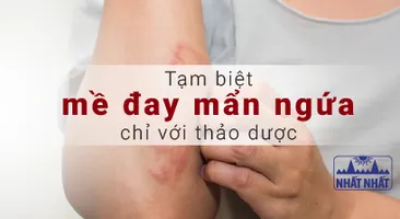 Tạm biệt mề đay mẩn ngứa chỉ với thảo dược đảm bảo hiệu quả