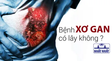 Bệnh xơ gan có lây không? Làm sao để phòng ngừa và điều trị hiệu quả?