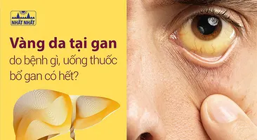 Vàng da tại gan do bệnh gì, uống thuốc bổ gan có hết?