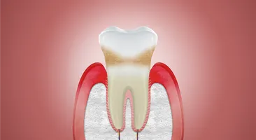Đừng để tụt lợi nặng gây mất thẩm mỹ và mất răng!