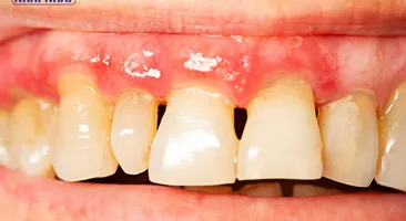 Nhận biết các giải pháp hiệu quả cho người bị viêm chân răng
