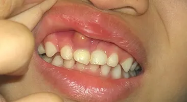 Mách mẹ cách trị viêm lợi có mủ ở trẻ em cực kỳ hiệu quả