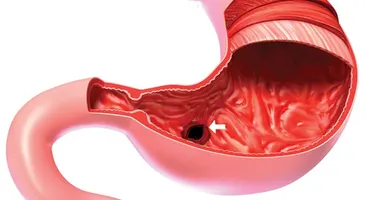Viêm xung huyết dạ dày điều trị như thế nào?