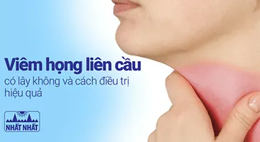 Viêm họng liên cầu có lây không và cách điều trị hiệu quả