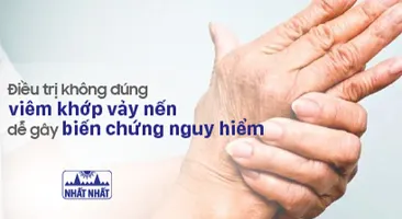 Điều trị không đúng viêm khớp vảy nến dễ gây biến chứng nguy hiểm