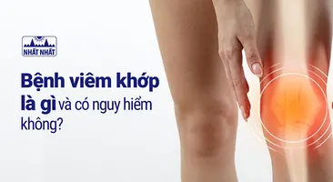 Bệnh viêm khớp là gì và có nguy hiểm không?