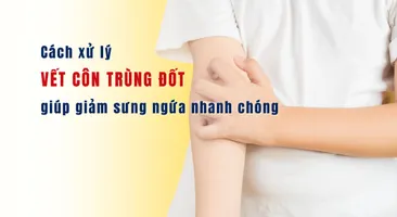 Cách xử lý vết côn trùng đốt giúp giảm sưng ngứa nhanh chóng