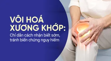 Vôi hoá xương khớp: Chỉ dẫn cách nhận biết sớm, tránh biến chứng nguy hiểm
