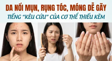 Da nổi mụn, rụng tóc, móng dễ gãy - tiếng "kêu cứu" của cơ thể thiếu kẽm