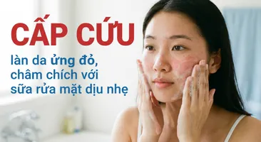 "Cấp cứu" làn da ửng đỏ, châm chích với sữa rửa mặt dịu nhẹ