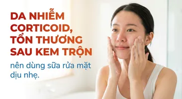 Da nhiễm corticoid, tổn thương sau kem trộn: nên dùng sữa rửa mặt dịu nhẹ