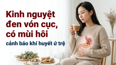 Kinh nguyệt đen vón cục, có mùi hôi: cảnh báo khí huyết ứ trệ