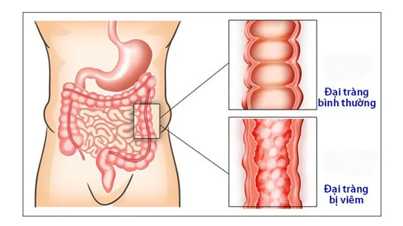 bài thuốc chữa viêm đại tràng