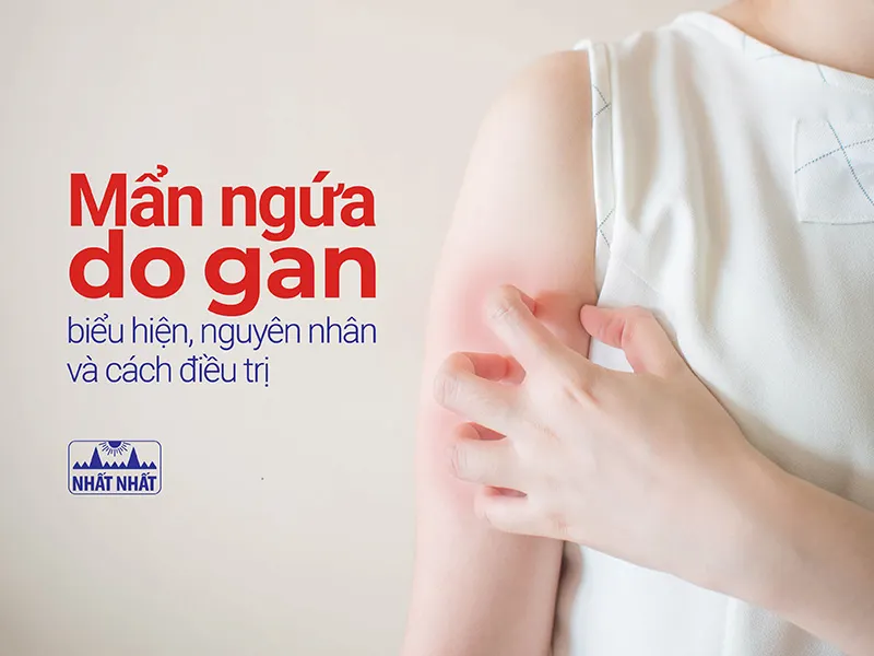 mẩn ngứa nóng trong do gan 
