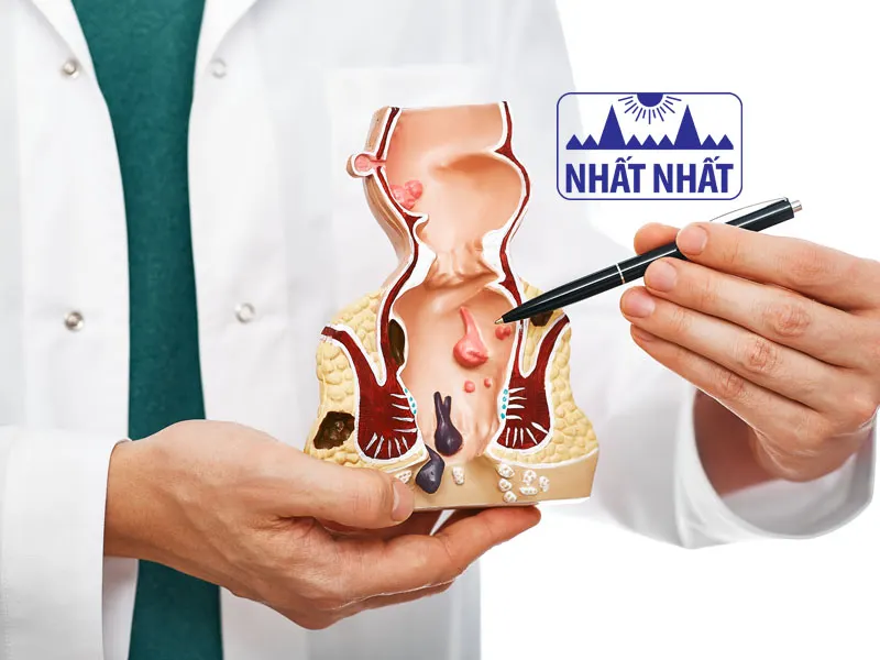 bệnh trĩ và cách điều trị tại nhà