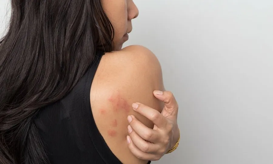 Da nổi mụn, mẩn ngứa là dấu hiệu cơ thể tích tụ chất độc