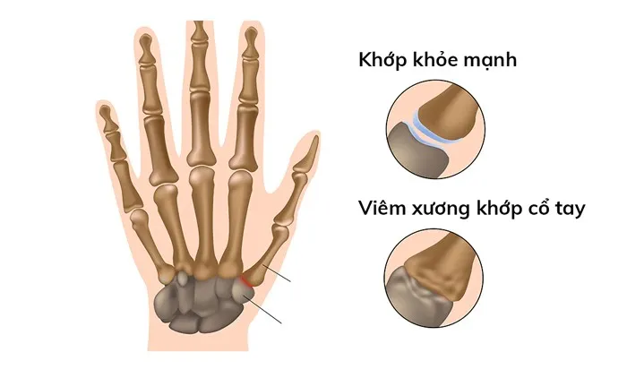 đau khớp cổ tay