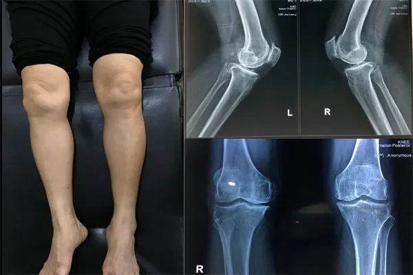 đau nhức đầu gối là bệnh gì