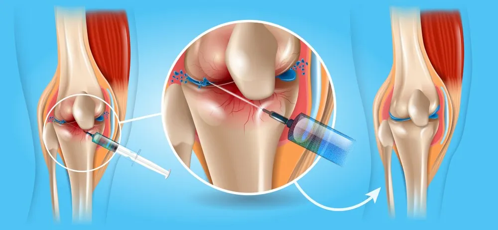 đau nhức đầu gối là bệnh gì