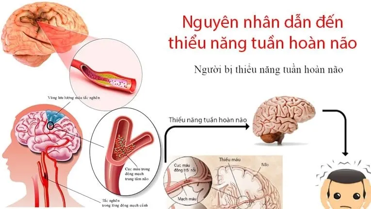 Đau nửa đầu sau