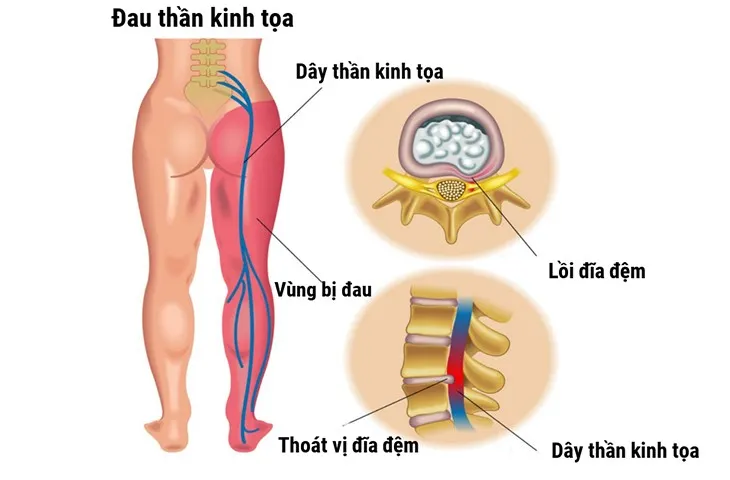 Đau thần kinh tọa t