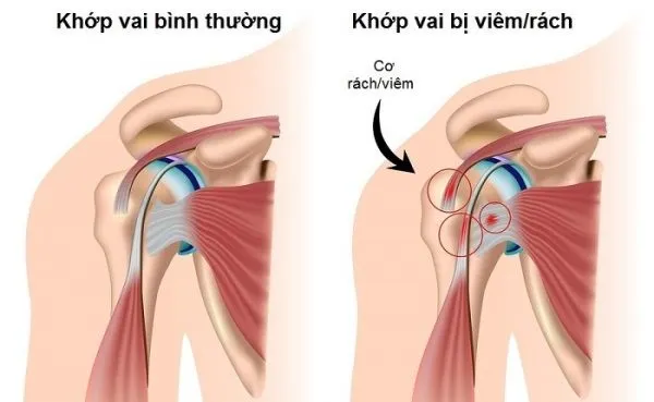 đau xương vai