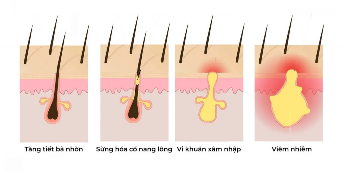 giảm mụn tại nhà